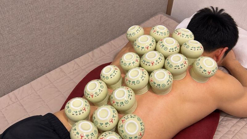 만성 요추 염좌 치료용 침과 부항 컵이 놓인 진료대